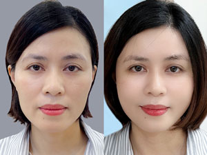 Before-After cấy mỡ