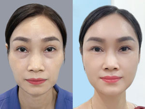 Before-After cấy mỡ