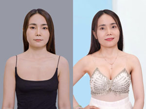 Before-After nâng ngực