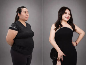 Before-After hút mỡ