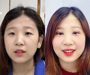 Before-After thẩm mỹ mắt
