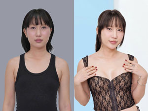 Before-After nâng ngực