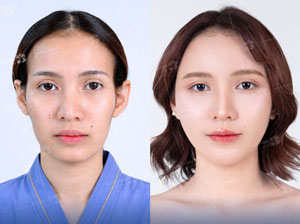 Before-After cấy mỡ