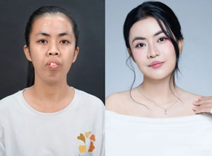 Before-After hàm mặt