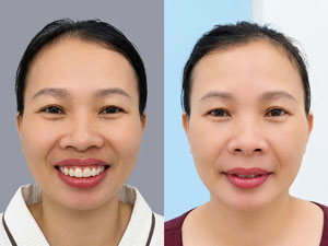 Before-After hàm mặt