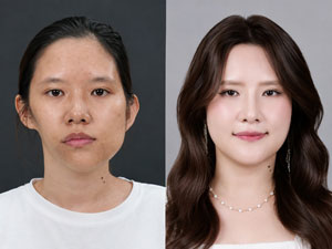 Before-After hàm mặt