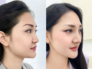 Before-After nâng mũi