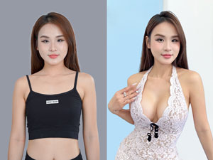 Before-After nâng ngực