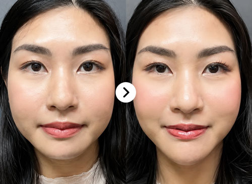 Cằm lẹm Before After