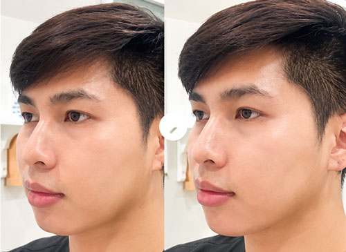 Cằm lẹm Before After