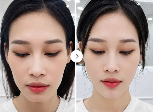 Cằm lẹm Before After