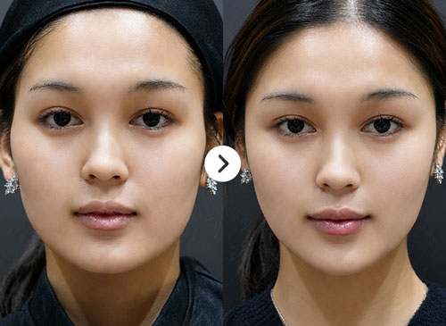 Rãnh cười sâu Before After