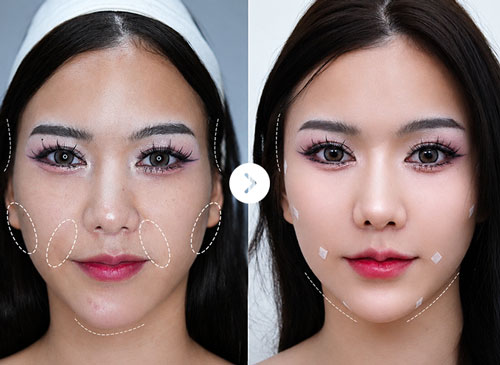 Rãnh cười sâu Before After