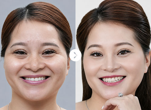 Rãnh cười sâu Before After
