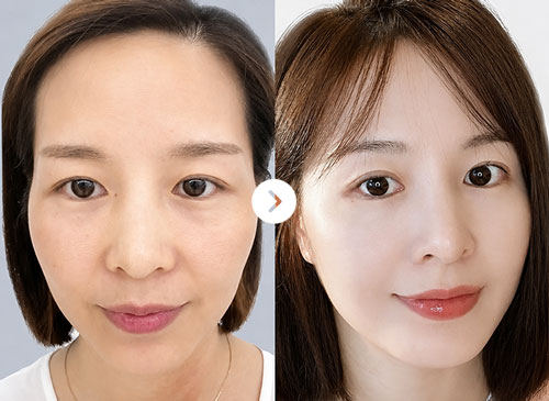 Thái dương hóp Before After