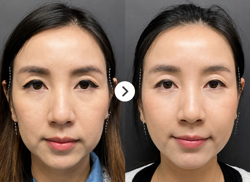 Thái dương hóp Before After