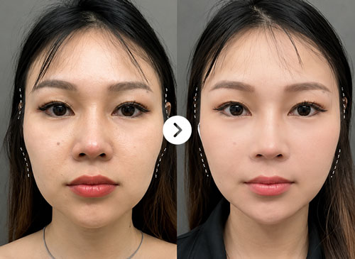 Thái dương hóp Before After