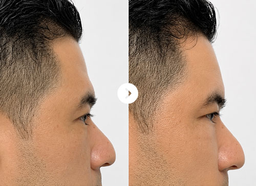 Cằm lẹm Before After