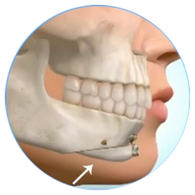 TRƯỢT CẰM TỰ THÂN