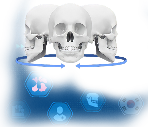 Mô phỏng hạ gò má