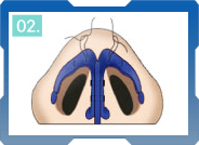CÁC BƯỚC THU GỌN CÁNH MŨI