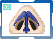 CÁC BƯỚC THU GỌN CÁNH MŨI