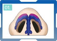 CÁC BƯỚC THU GỌN CÁNH MŨI