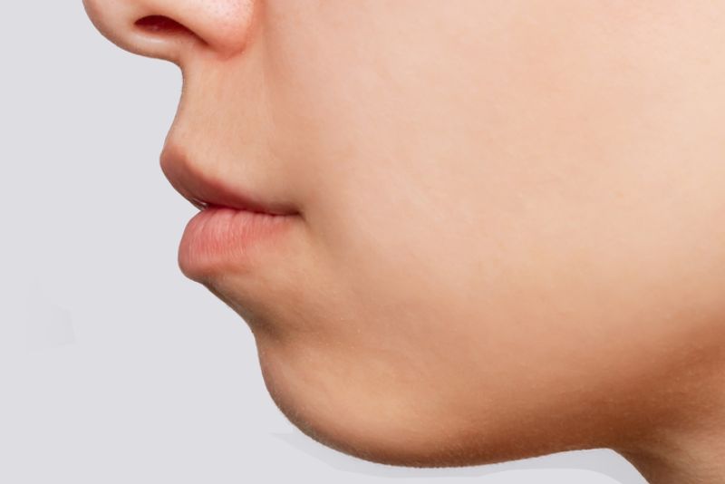 Cằm lẹm khiến hàm trên có cảm giác bị hô