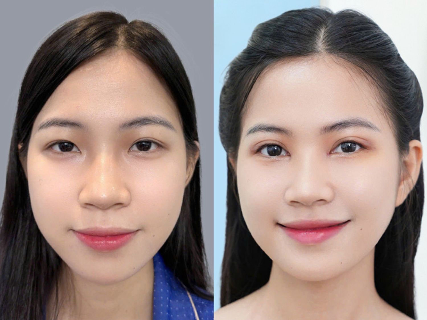 Thời điểm nếp mí đã ổn định, vào form hài hòa
