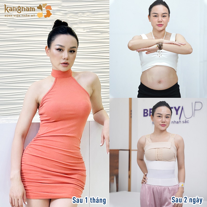 Chị em nên đeo đai định hình sau khi hút mỡ bụng