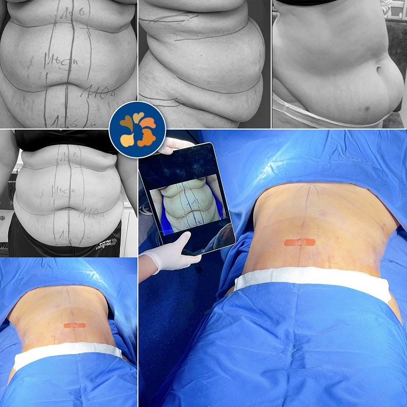 Vùng eo thon gọn sau khi thực hiện hút mỡ bụng nội soi tại cơ sở thẩm mỹ uy tín