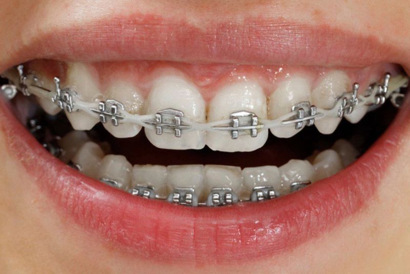 Kết hợp niềng răng chỉnh sửa mặt lưỡi cày trong một số trường hợp
