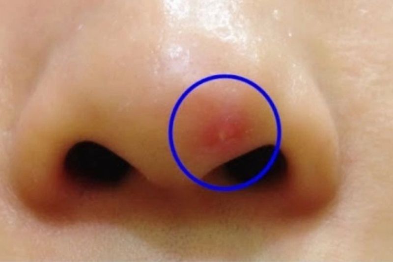 Biến chứng sau nâng mũi