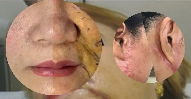 Da bị tổn thương khi căng chỉ không đúng cách