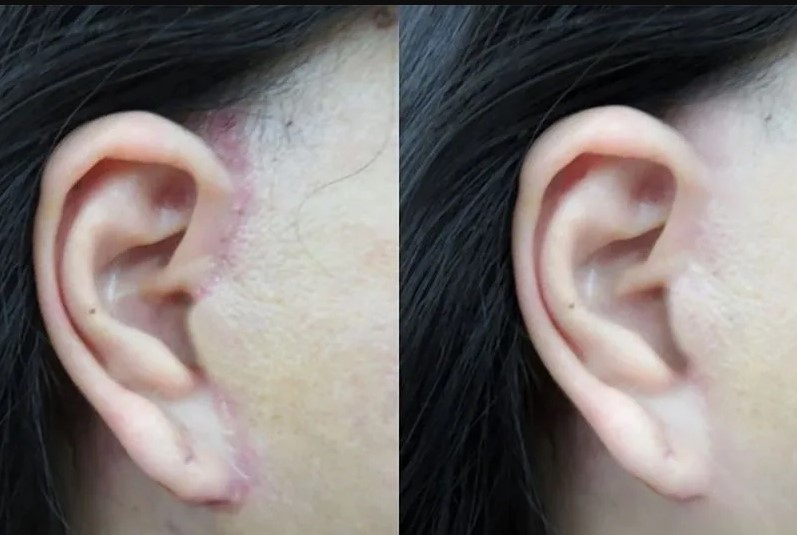 Ăn hải sản quá sớm có thể để lại sẹo ở vùng da căng da mặt