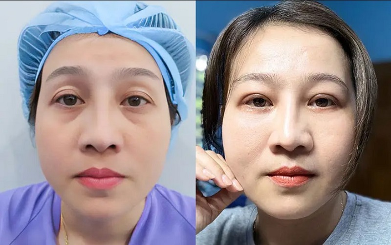 Hốc mắt trũng sâu được đầy đặn hơn sau cấy mỡ