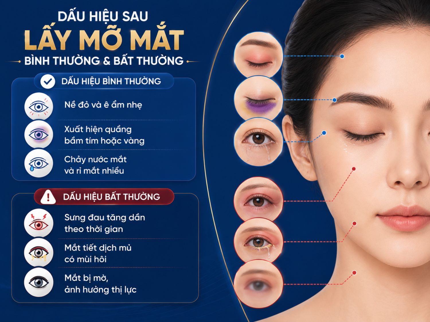 Một số biểu hiện như sưng nhẹ, bầm tím hay chảy nước mắt là phản ứng thường gặp sau lấy mỡ mắt. Tuy nhiên, nếu sưng đau tăng dần, xuất hiện dịch mủ hoặc ảnh hưởng thị lực, người bệnh nên liên hệ bác sĩ để được kiểm tra kịp thời.