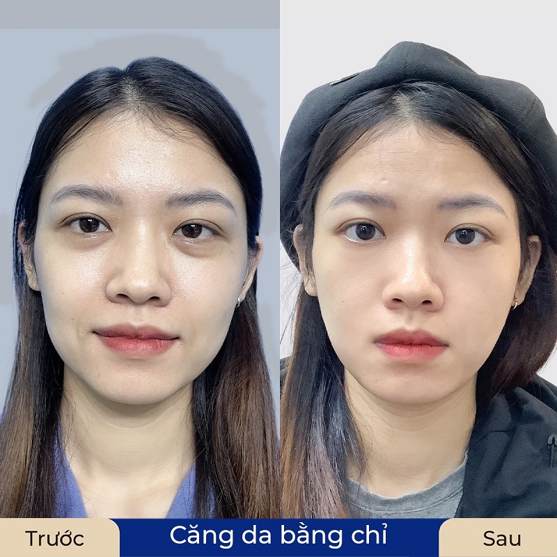 Gương mặt được nâng đỡ tươi trẻ và mịn màng 