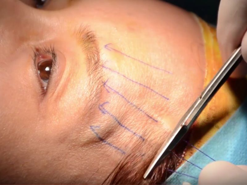 Nâng cung chân mày giấu chỉ có thể gây dị ứng