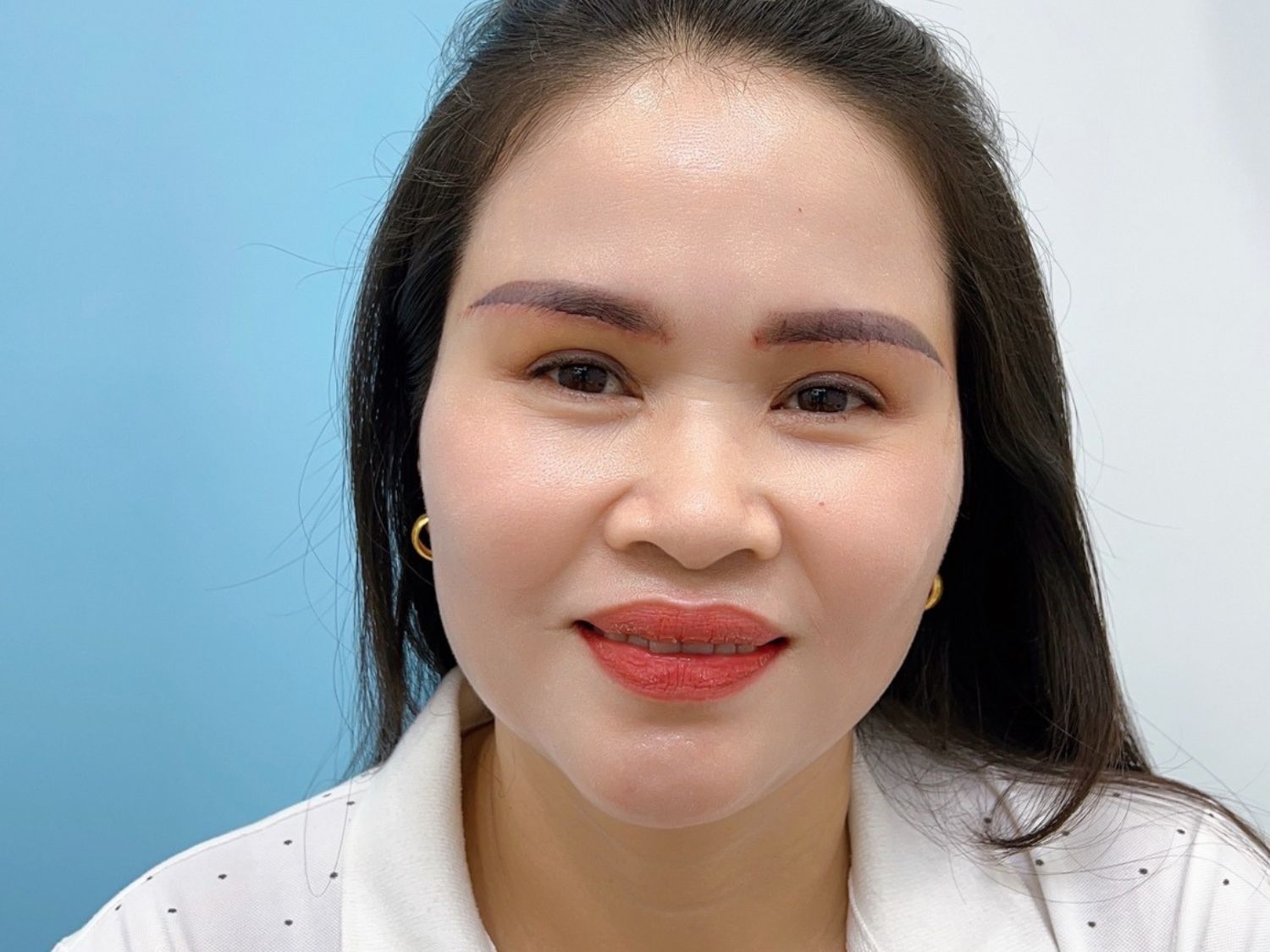 Vết thương cung mày đã khô và liền lại, lúc này khách hàng sẽ được cắt chỉ