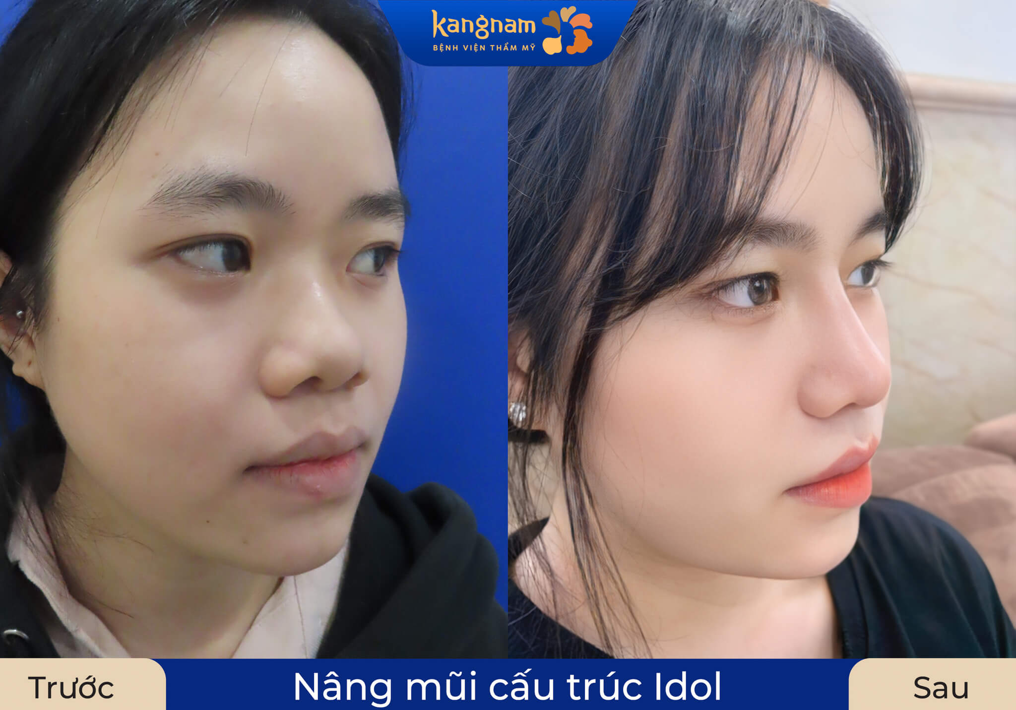 Đầu mũi giọt nước mềm mại, khắc phục tình trạng mũi hếch hay lộ sóng