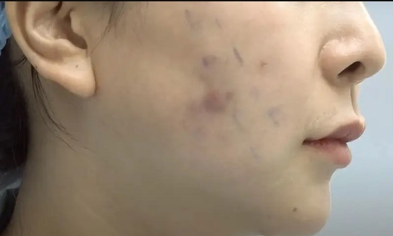 Nhiễm trùng sau cấy chỉ