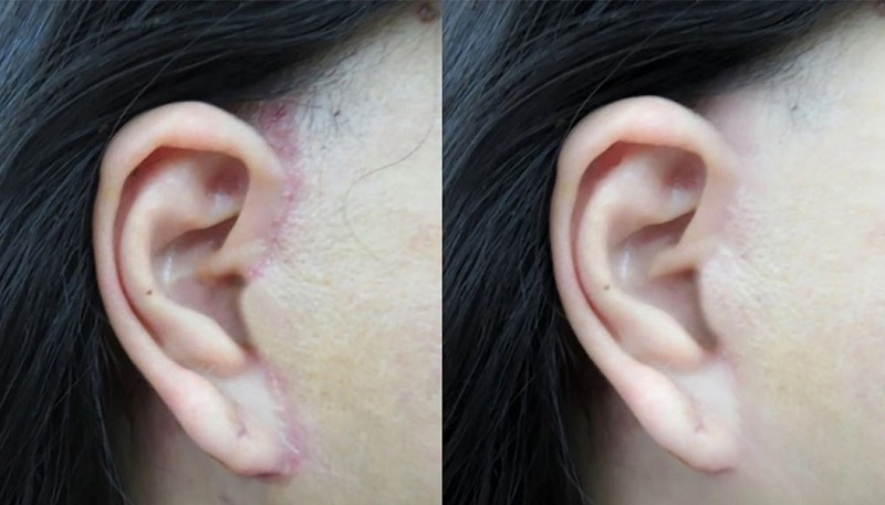 Để lại sẹo vùng mặt nếu không được thực hiện đúng kỹ thuật