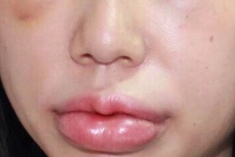 Biến dạng môi do tiêm filler sai cách