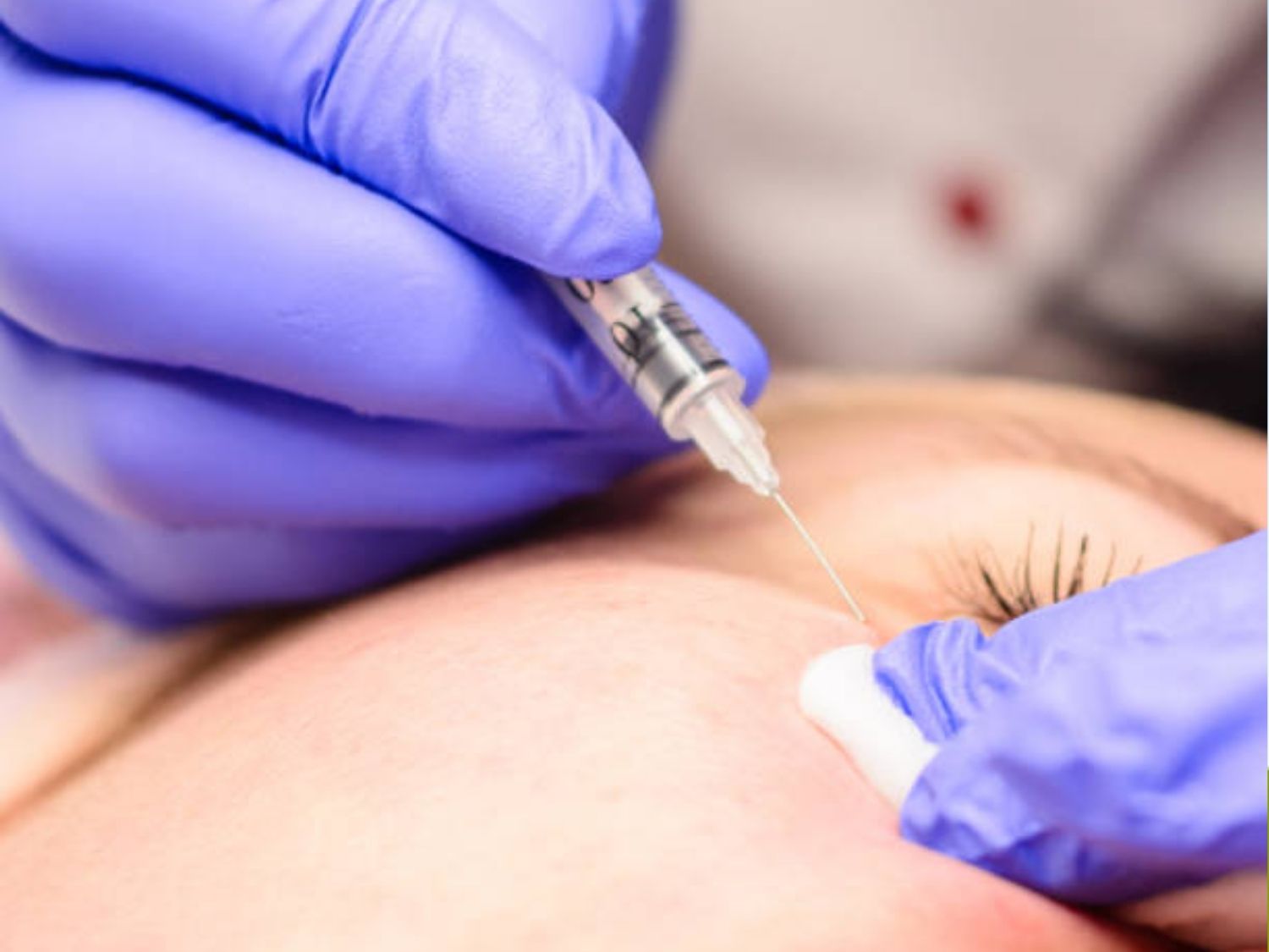 tiêm tan filler xong thường sẽ bị sưng tại vùng tiêm