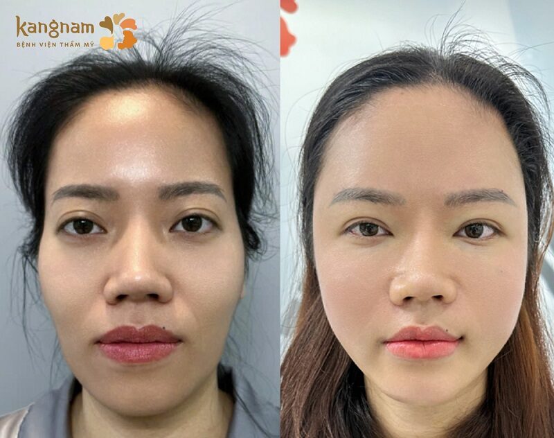 Cấy mỡ giúp kích thích sản sinh collagen, duy trì vẻ đẹp lâu bền