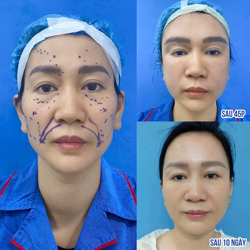 Cấy mỡ mặt tại Kangnam khắc phục hiệu quả các khuyết điểm trên mặt