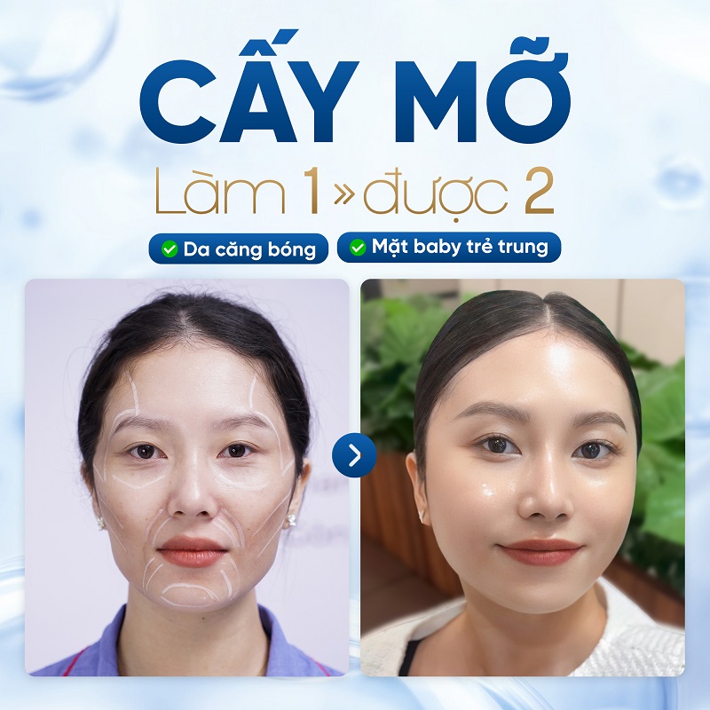 Sau cấy mỡ mặt khuôn mặt được căng bóng, mịn màng hơn