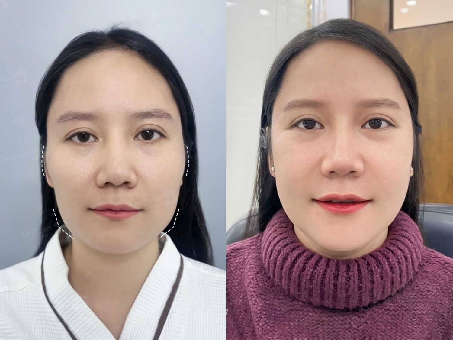 khách hàng Kim Thoa trước và sau khi hạ gò má tại Kangnam, gương mặt cân đối và trẻ trung hơn