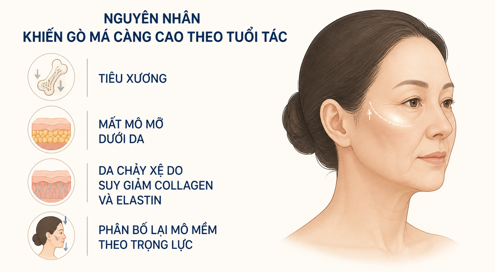 ảnh mô tả các nguyên nhân khiến càng lớn tuổi gò má càng có xu hương bị cao lên